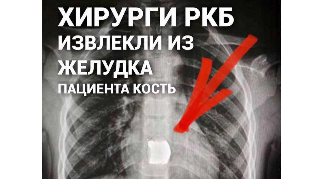 Хирурги РКБ извлекли из желудка пациента кость